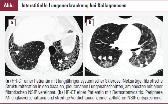 Interstitielle Lungenerkrankung Bei Kollagenosen | FAKTEN Der Rheumatologie