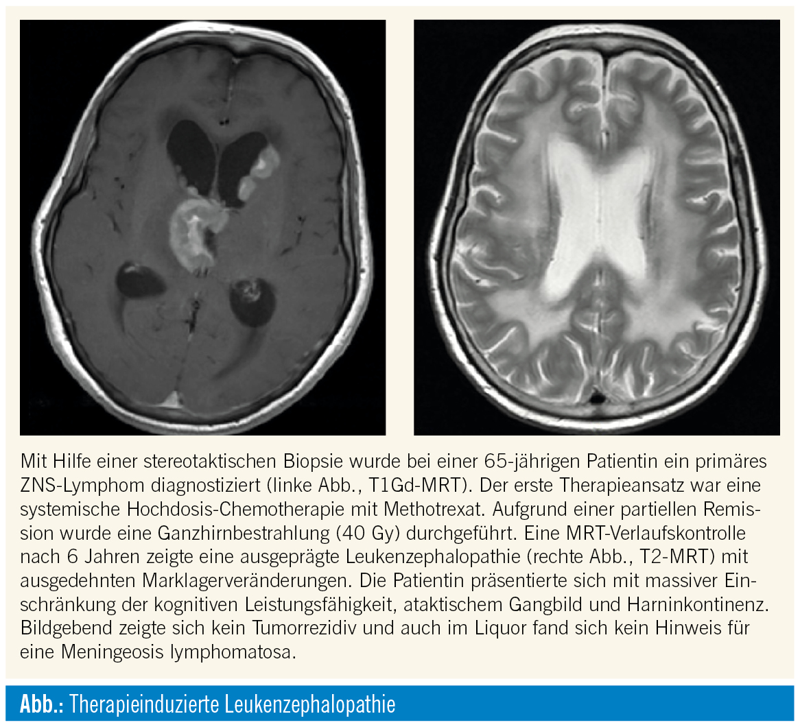 Chemotherapieinduzierte Neurologische Langzeittoxizitäten | Spectrum ...